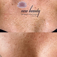 napfoltok/vitiligo tetoválás